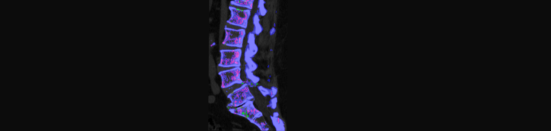 Poulin Chiropractic of Herndon and Ashburn is aware that inflammatory spinal gout is a differential diagnosis to consider for patients who present with back pain and other spine related symptoms.