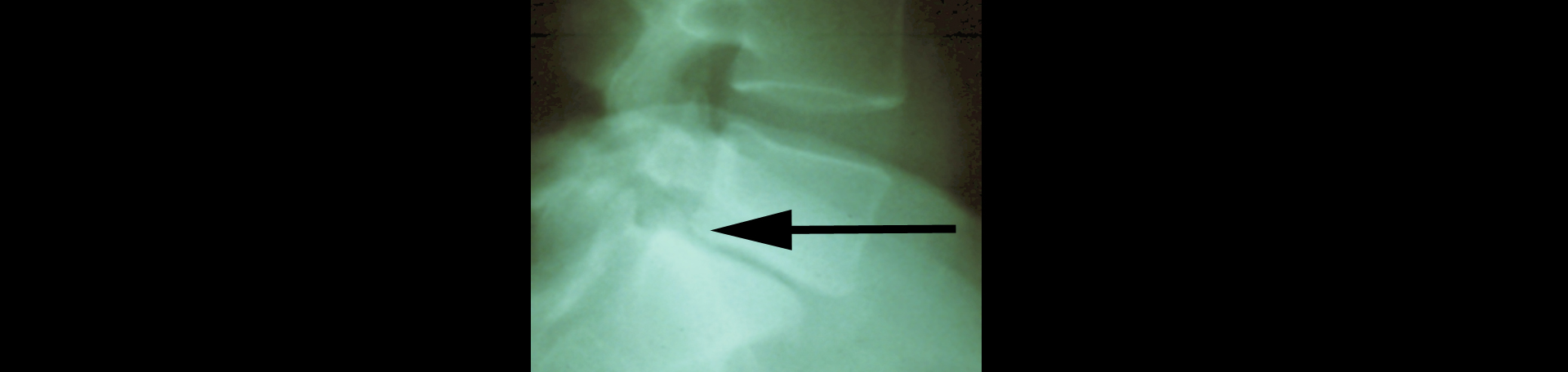 Ashburn and Herndon spondylolisthesis 