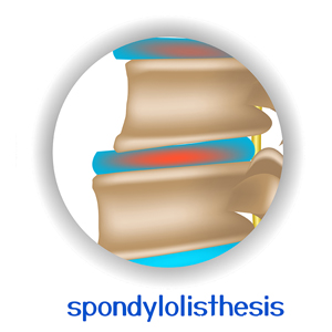 image of Ashburn and Herndon chiropractic spondylolisthesis